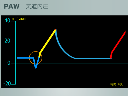 人工呼吸器 グラフィックの説明マニュアル 9 気道内圧波形: MEの『これ 